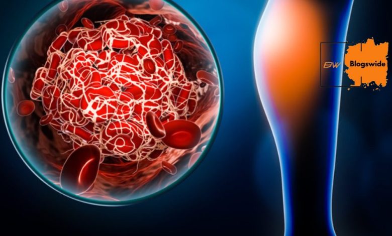 How Fast Does A Blood Clot Travel From The Leg To The Lungs?