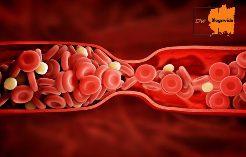 How Fast Does a Blood Clot Travel from the Leg to the Lungs? | Blogswide.com